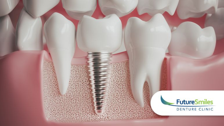 Revolutionizing Dental Care: The Next Wave of Implant Technology